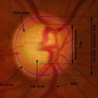 Comparison cup/disc ratio for suspect cases with the measure of an ...