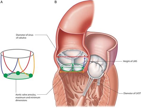 Aortic Valve Annulus