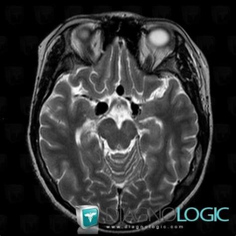 Radiology case : Vasculitis (MRI) - Diagnologic