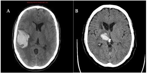 Intracerebral Hemorrhage Locations