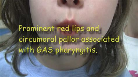 Strep Throat and Scarlet Fever - YouTube