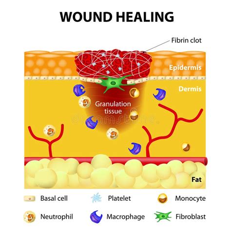 Process of wound healing stock vector. Image of injury - 51251717