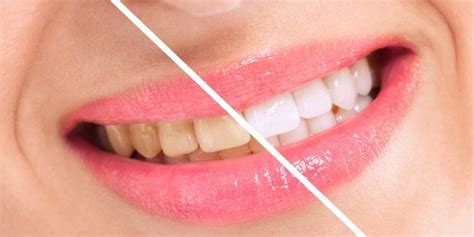 Side Effects of Teeth Whitening | Byford Smiles