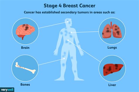 Traitements locaux des métastases du cancer du sein - Fmedic