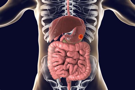 Quiz: Gastric/Gastroesophageal Junction Cancer Treatment