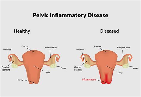 Pelvic Inflammatory Disease In Hindi - blogrotu1