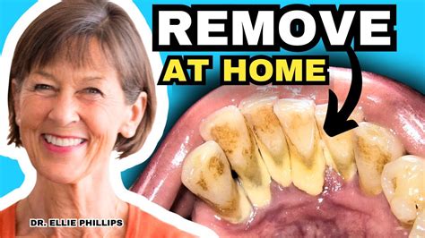 Tartar Removal At Home and How To Prevent Tartar - YouTube