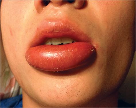 Lip Abscess Associated With Isotretinoin Treatment | Acne | JAMA Dermatology | The JAMA Network