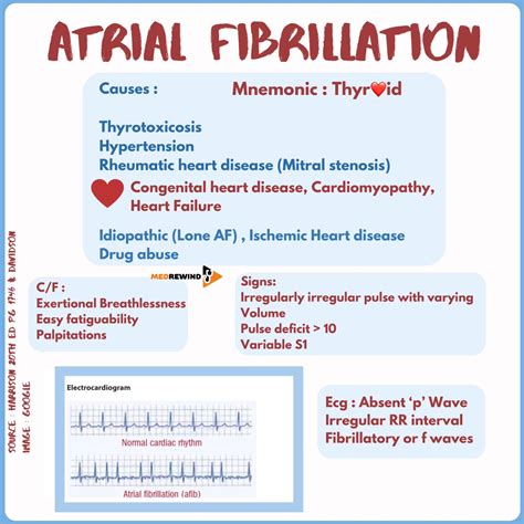 Atrial fibrillation | Atrial fibrillation | By MedRewind