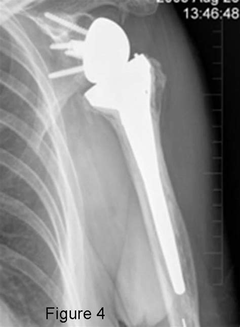 Reverse Total Shoulder Replacement | Johns Hopkins Department of ...