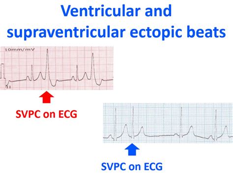 Sinus Rhythm With Ventricular Ectopics Shop | www.jkuat.ac.ke