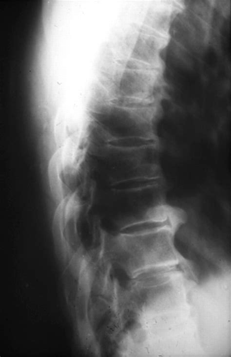 diffuse idiopathic skeletal hyperostosis treatment | fulfere