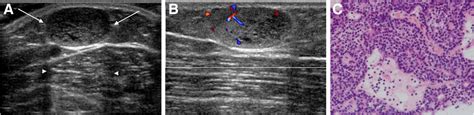 Ultrasonographic Features of Eccrine Spiradenoma - Hwang - 2018 ...