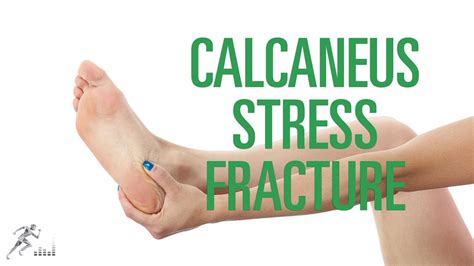 life after a calcaneus stress fracture - Ahmed Benitez