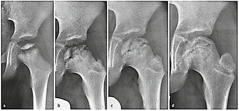 Legg-Calve-Perthes Disease – Core EM