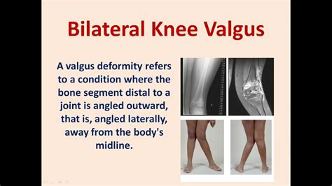 Knee Valgus Deformity || Rheumatoid Knee || Rheumatoid Valgus Knee - YouTube