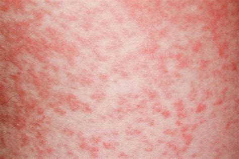 Amoxicillin Rash In Glandular Fever Photograph by Dr P. Marazzi/science ...