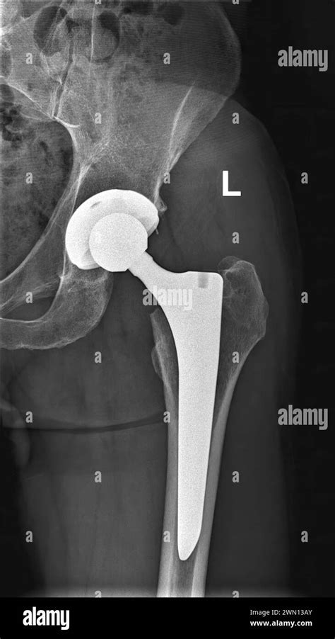 X-ray of left hip prosthesis. AP view. 12 weeks after total hip replacement Stock Photo - Alamy