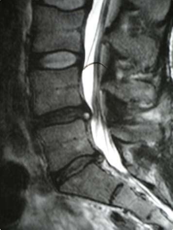 Degenerative Disc Disease at L4-L5 and L5-S1