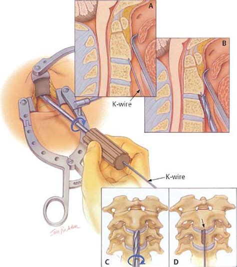 83 Type 2 Odontoid Fracture | Neupsy Key