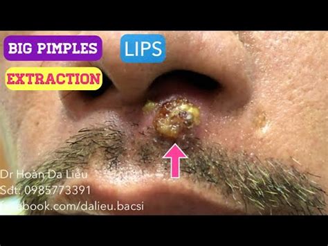 Nặn mụn nhọt khủng vùng môi siêu to|Squeeze super big big pimples,pustule, anti acne, acne ...