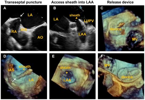 Role of real time‑three dimensional transesophageal echocardiography in ...