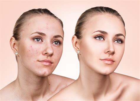 The Skin Before and after Acne Removal by the Experts