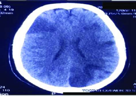 NCCT head showing multiple infarcts. | Download Scientific Diagram