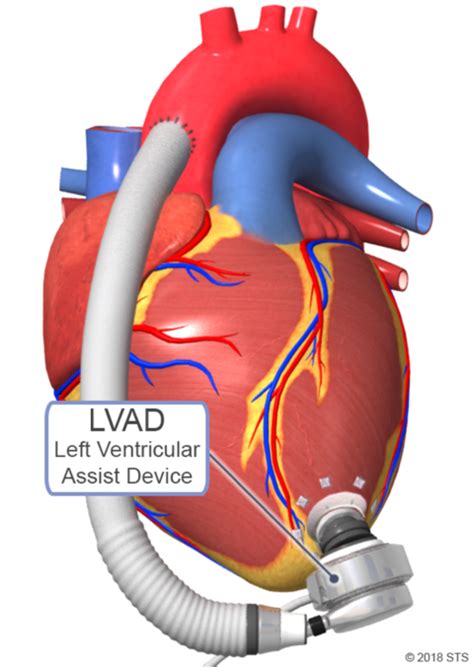 Left Ventricular Assist Device - Newport Cardiac & Thoracic Surgery