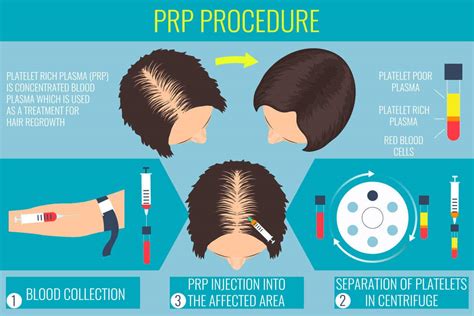 Platelet Rich Plasma Hair Therapy PRP injections are a proactive therapeutic option for male and ...