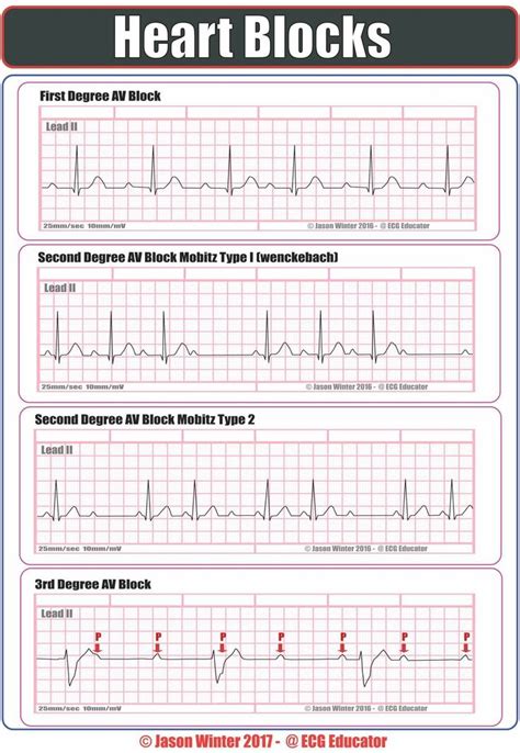 Heart Blocks | Medical surgical nursing, Emergency nursing, Cardiac nursing