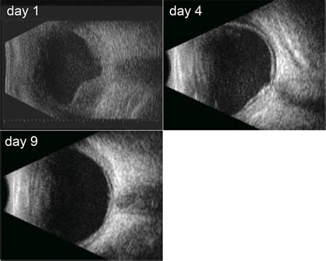 B-scan ultrasound of the right eye showing vitreous opacities and an... | Download Scientific ...