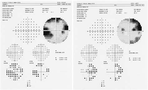 Glaucoma & Optic Nerve Imaging Toronto | Skouras Eye & Cosmetic