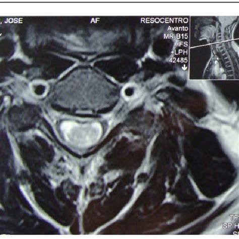 B: Preoperative Axial T2 MRI Showing solid ependymoma, which represents... | Download Scientific ...