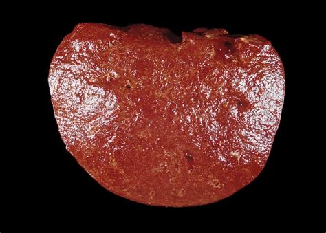 Spleen Cancer, Gross Specimen Photograph by Science Photo Library