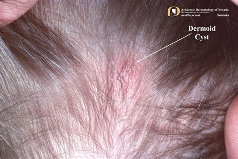 Dermoid Cysts: Once Upon A Time... - Academic Dermatology of Nevada