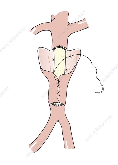 Vascular graft surgery, illustration - Stock Image - C028/9094 - Science Photo Library