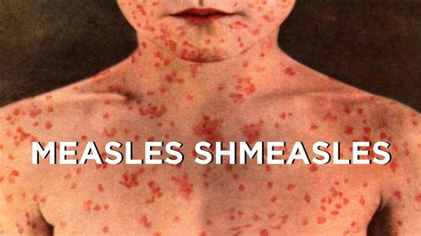 Measles Vaccine Shmeasles | The Measles Scare of 2015