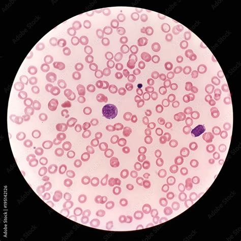 Human blood smear under 100X light microscope with blast cells ...