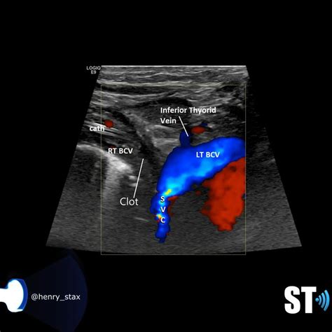 Upper Extremity Venous Doppler – Sonographic Tendencies | Vascular ultrasound, Medical ...