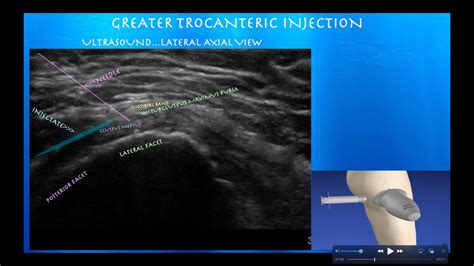 Ultrasound Guided Subacromial Bursa Injection With An - vrogue.co