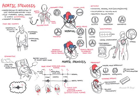 Aortic Stenosis - Armando Hasudungan