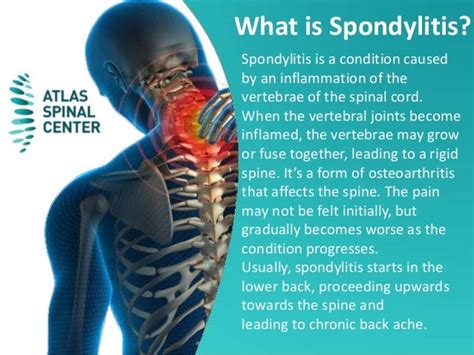 What is spondylitis