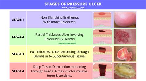 Wounds Pressure Ulcers Staging