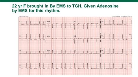 SVT on the ECG! — USF Emergency Medicine