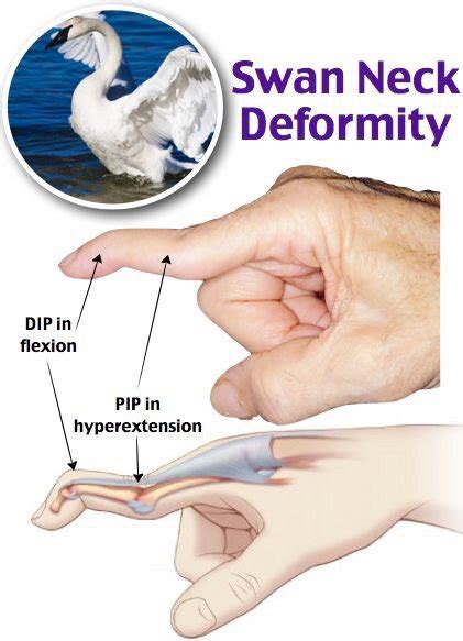 What I learned today - Hand Deformities | Medical Amino