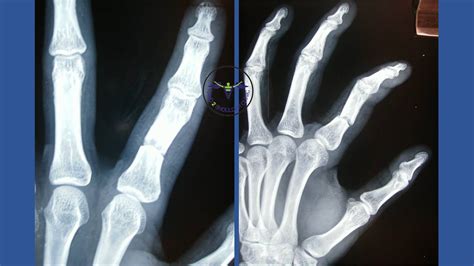 proximal phalanx fracture | Hand2Shoulder Clinic