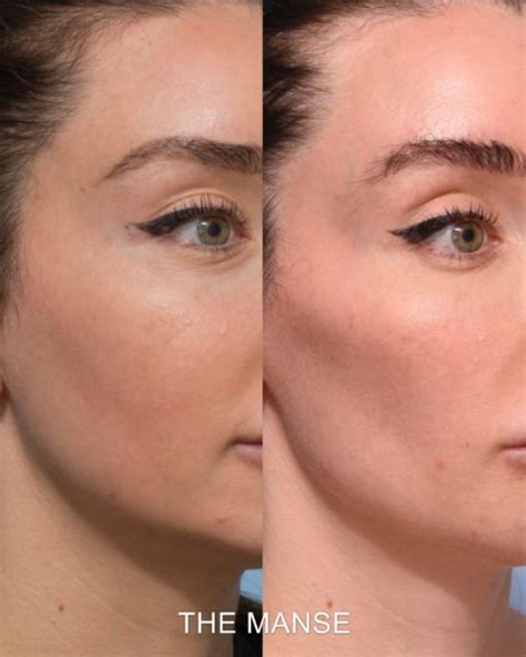 Cheek fillers before and after: Sydney dermal filler clinic