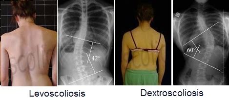 Mild Thoracic Dextroscoliosis: What Does It Mean? | Scoliosis SOS