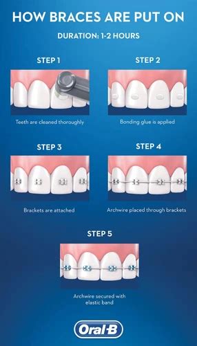 How Long Does Braces Glue Take to Dry? Learn the Process